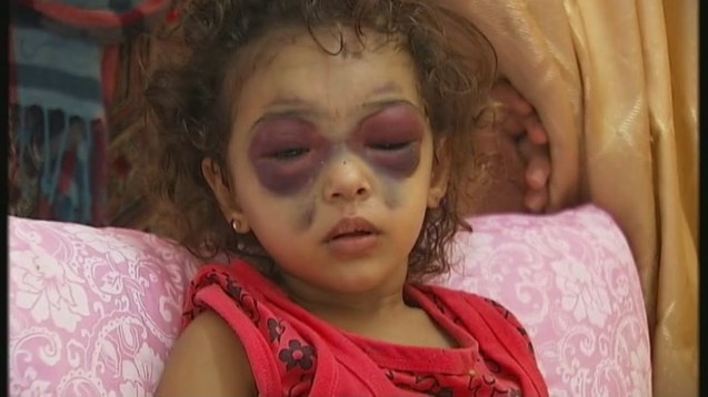 Menina palestiniana com o crânio e o nariz fracturado na sequência de um ataque israelita. A reportagem que o jornalista Jon Snow da cadeia de televisão britânica Channel 4 fez com esta criança tornou-se mais um dos símbolos desta "guerra" © Direitos Reservados | All Rights Reserved