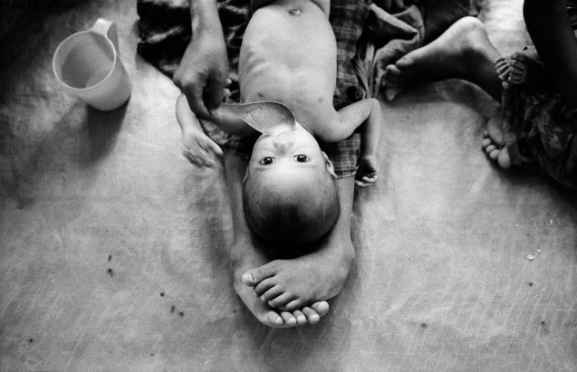 BANGLADESH. Maricha. 1/06/1992: Burmese (Rohingya) refugees. Nutrition center run by MSF. ©http://www.johnvink.com/