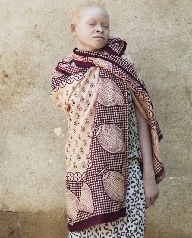 Kabula N. Masanja : 12 anos É uma sobrevivente. Perdeu o braço direito, cortado com um machado. até à axila. Os criminosos deixaram-na a sangrar e fugiram com uma parte do corpo dela para vender a feiticeiros. Kabula regressou há pouco tempo de Nova Iorque onde recebeu uma prótese que substitui o braço amputado. © Cortesia de | Courtesy of Patrick Gries