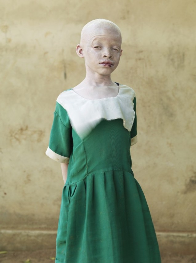 Regina Matias : 9 anos O seu rosto já evidenciava sinais de melanoma devido ao sol. A maioria das crianças albinas pobres morre antes dos 30 anos. São muitas as que sofrem de cancro de pele por não usarem protectores solares, chapéus e óculos escuros. Regina está vestida com um uniforme escolar, mas provavelmente nunca chegará a frequentar as aulas. © Cortesia de | Courtesy of Patrick Gries